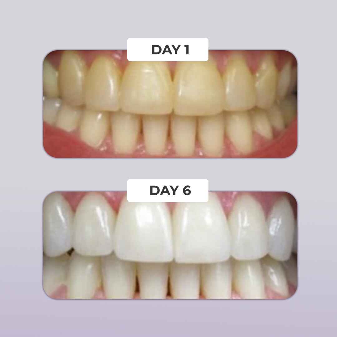 PUURSMILE TEETH WHITENING KIT - 60% OFF CHRISTMAS SALE