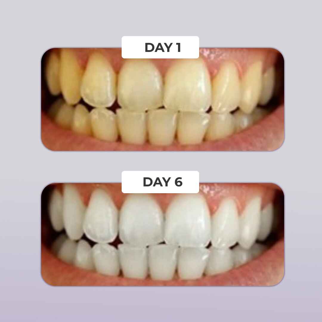PUURSMILE TEETH WHITENING KIT - 60% OFF CHRISTMAS SALE